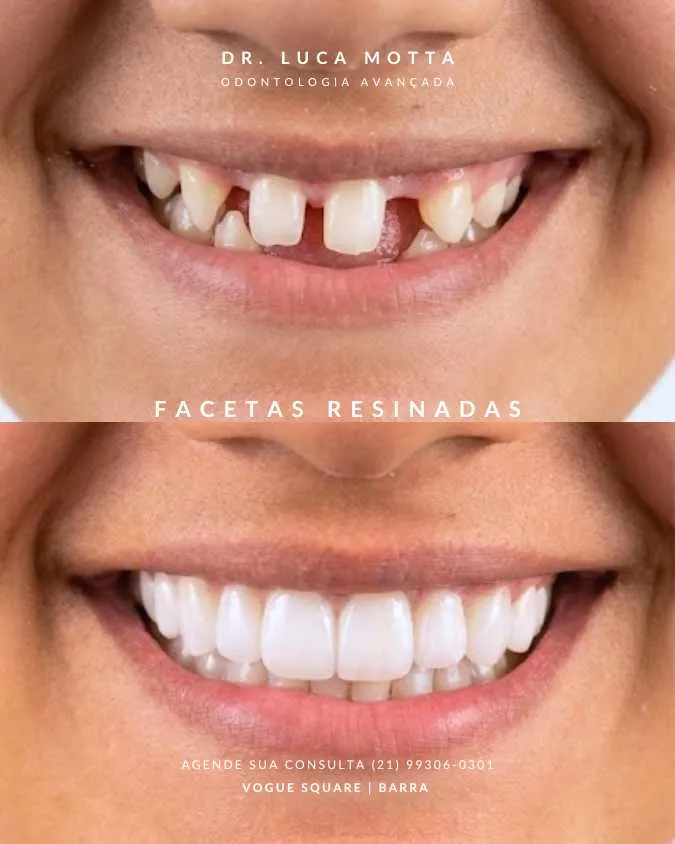 Resultado de Transformação de Sorriso pelo Dr. Luca Motta