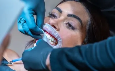 Clareamento Dental Profissional