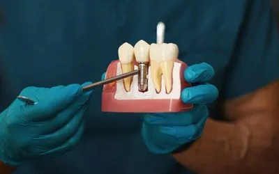 Implantes Dentários de alta precisão na Barra da Tijuca